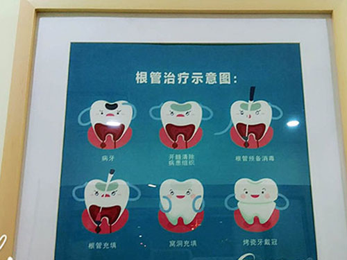 根管治疗